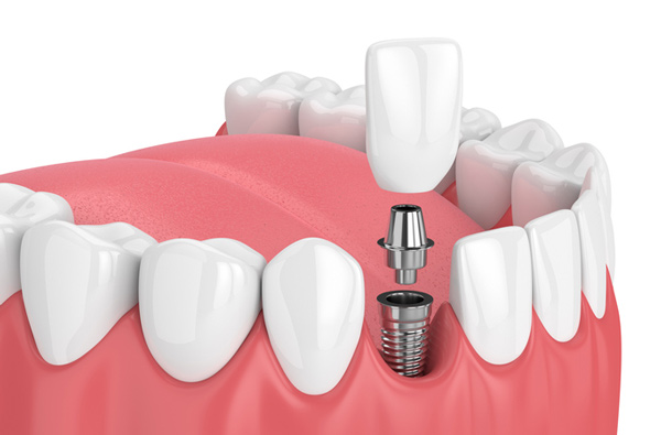 dental implants in kalamazoo