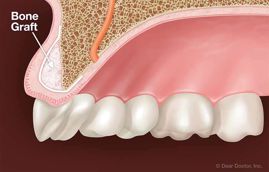 periodontal bone grafting