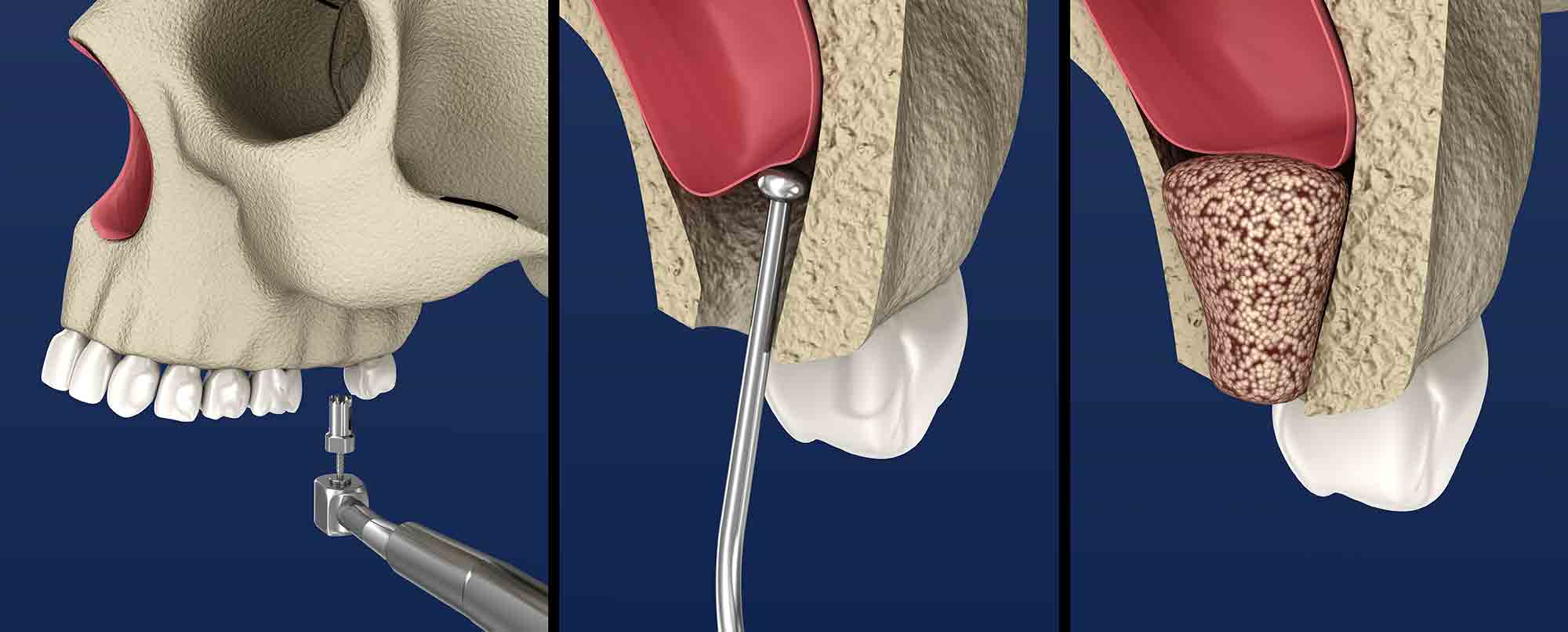 sinus augmentation